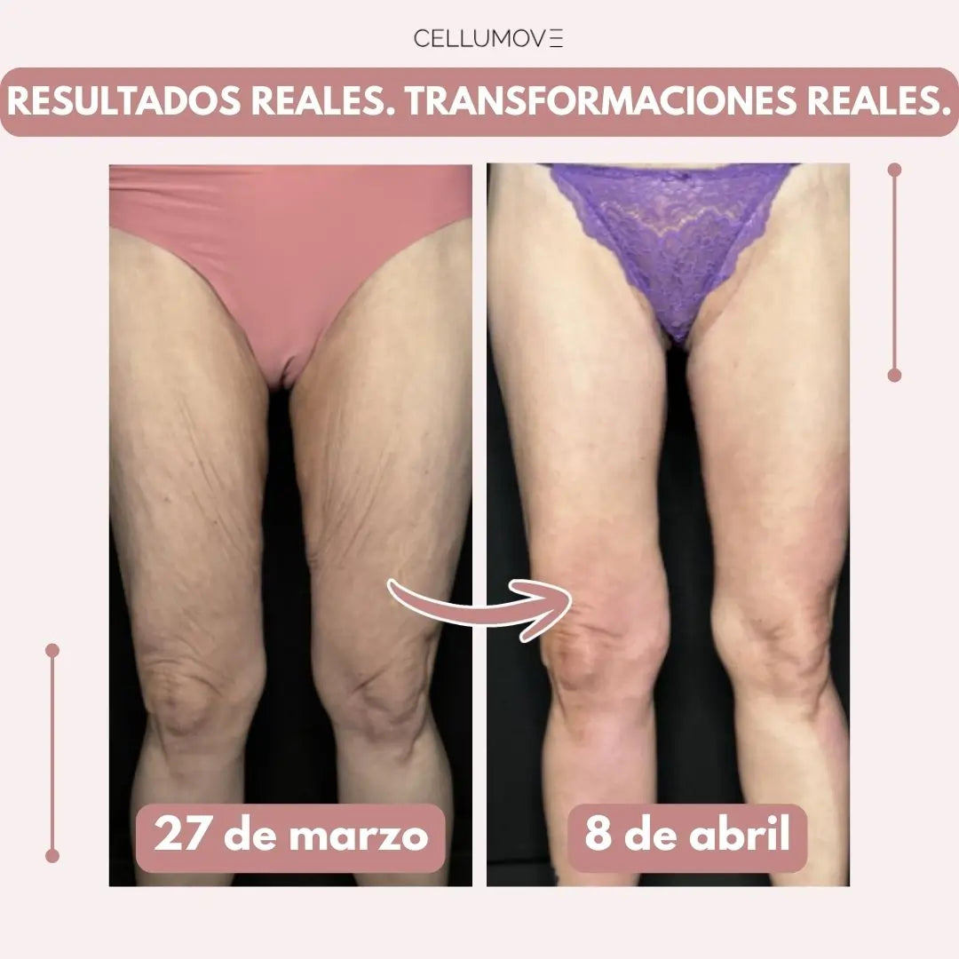 Piernas más firmes y suaves en 14 días — para mujeres cansadas de que la piel flácida las detenga (modelo normal)