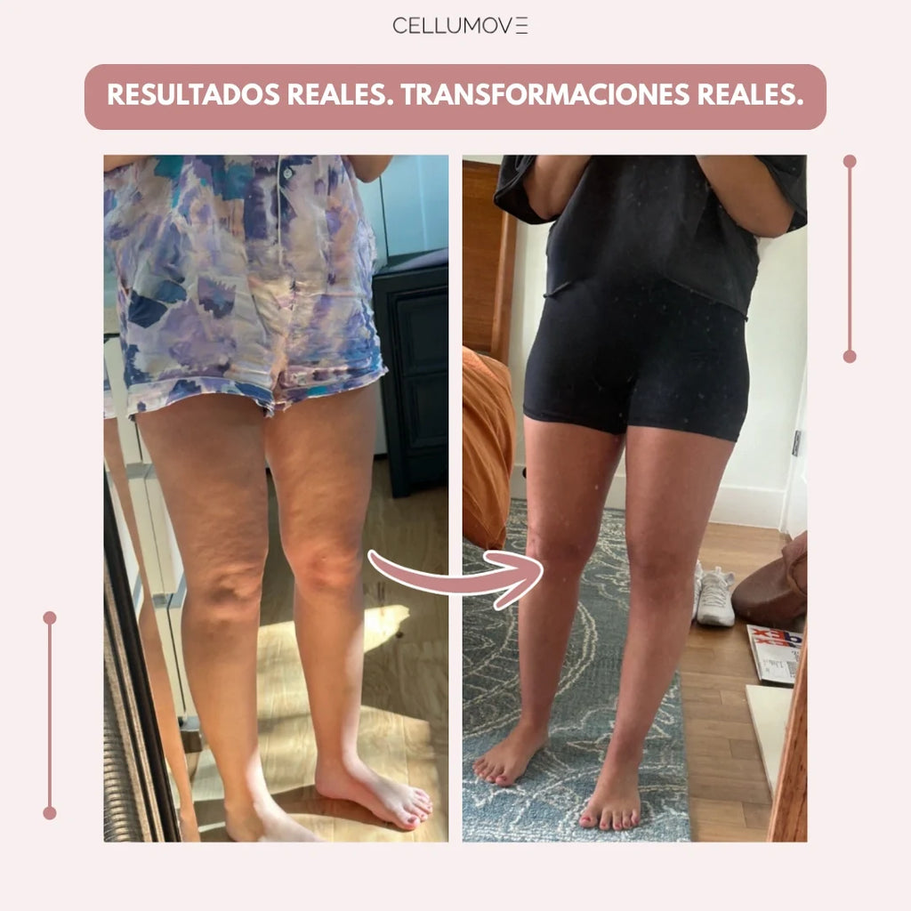 Cellumove 3D Legging – Despídete del dolor y la fatiga del lipoedema de forma natural