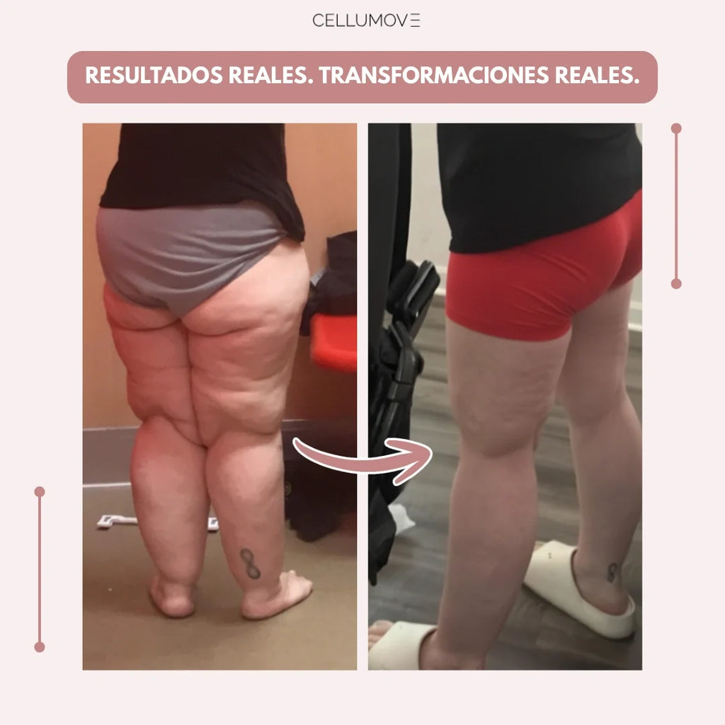 Cellumove 3D Legging – Despídete del dolor y la fatiga del lipoedema de forma natural