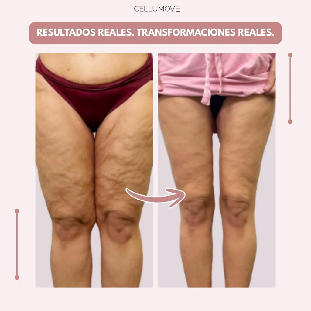 Cellumove 3D Legging – Despídete del dolor y la fatiga del lipoedema de forma natural
