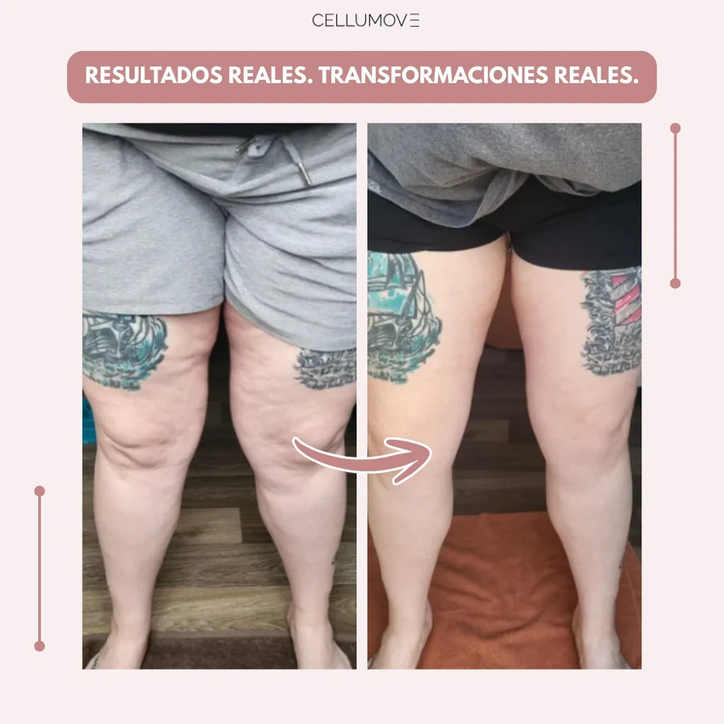 Cellumove 3D Legging – Despídete del dolor y la fatiga del lipoedema de forma natural