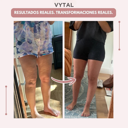 VYTAL 3D Legging – Despídete del dolor y la fatiga del lipoedema de forma natural