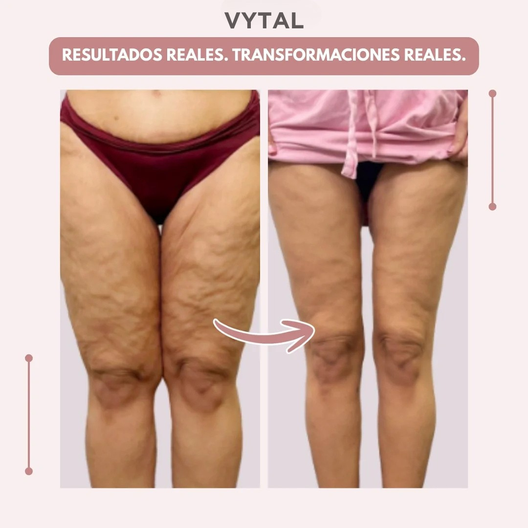 VYTAL 3D Legging – Despídete del dolor y la fatiga del lipoedema de forma natural